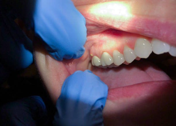 Best Emergency Dental Extractions in Cana, VA
